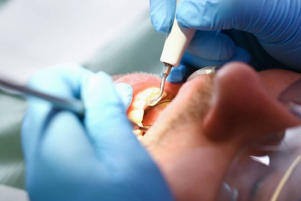 Best Emergency Treatment for Dental Infections or Abscesses in Claremont, NH