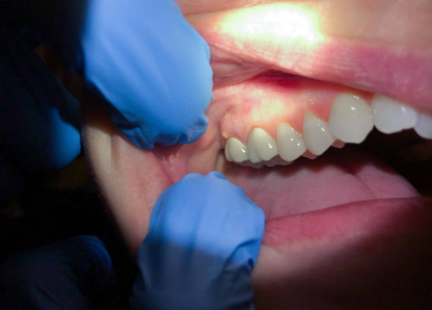 Best Emergency Dental Care for Broken or Chipped Teeth in Claremont, NH
